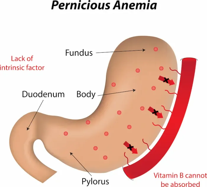 Symptoms, Causes, and Treatment of Pernicious Anaemia